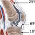 Симптомы, стадии и лечение тендинита коленного сустава и собственной связки надколенника Тендинит связки надколенника лечение